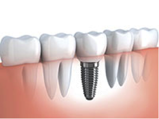 full mouth dental implants in tampa